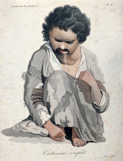 Cretinismo total, de un libro de Baron Jean Louis Alibert (1768-1837) de Salvadore Tresca